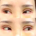 二重切開 / 目頭切開 / その他（目元） / 目尻切開 / タレ目形成・グラマラスライン（切開） id（アイディ）美容外科 DAY 11 サムネイル用