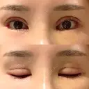 二重切開 / 目頭切開 / その他（目元） / 目尻切開 / タレ目形成・グラマラスライン（切開） id（アイディ）美容外科 DAY 12 サムネイル用