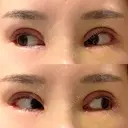 二重切開 / 目頭切開 / その他（目元） / 目尻切開 / タレ目形成・グラマラスライン（切開） id（アイディ）美容外科 DAY 12 サムネイル用