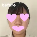 鼻中隔延長（切開） / 小鼻縮小（切開） / 軟骨移植 / 鼻尖縮小 / 鼻孔縁下降 / その他（鼻） 加美（GAMI）整形外科 DAY 24 サムネイル用