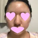 鼻中隔延長（切開） / 小鼻縮小（切開） / 軟骨移植 / 鼻尖縮小 / 鼻孔縁下降 / その他（鼻） 加美（GAMI）整形外科 DAY 27 サムネイル用