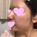 鼻中隔延長（切開） / 小鼻縮小（切開） / 軟骨移植 / 鼻尖縮小 / 鼻孔縁下降 / その他（鼻） 加美（GAMI）整形外科 DAY 27 サムネイル用