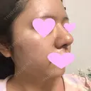 鼻中隔延長（切開） / 小鼻縮小（切開） / 軟骨移植 / 鼻尖縮小 / 鼻孔縁下降 / その他（鼻） 加美（GAMI）整形外科 DAY 27 サムネイル用