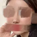 鼻尖形成（切開） / その他（鼻） / 軟骨移植 / 骨切幅寄せ / ワシ鼻修正・ハンプ切除 ソウルクイーン整形外科（旧コエンミ整形外科） DAY 150 サムネイル用