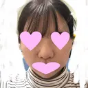 鼻中隔延長（切開） / 小鼻縮小（切開） / 軟骨移植 / 鼻尖縮小 / 鼻孔縁下降 / その他（鼻） 加美（GAMI）整形外科 DAY 28 サムネイル用