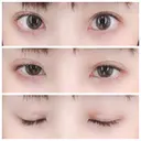 二重埋没 / 眼瞼下垂（切開） / クマ治療 / 下まぶたの脂肪取り THE MEDICAL SALON DAY 19 サムネイル用