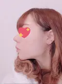 脂肪吸引（顔） / ボトックス（あご） / ボトックス（エラ・小顔） エートップ美容整形外科 DAY 269 サムネイル用