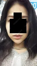 糸リフト ルラ美容クリニック 高田馬場院 DAY 15 サムネイル用