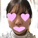 鼻中隔延長（切開） / 小鼻縮小（切開） / 軟骨移植 / 鼻尖縮小 / 鼻孔縁下降 / その他（鼻） 加美（GAMI）整形外科 DAY 29 サムネイル用