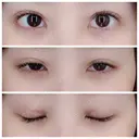 二重埋没 / 眼瞼下垂（切開） / クマ治療 / 下まぶたの脂肪取り THE MEDICAL SALON DAY 20 サムネイル用