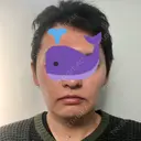 バッカルファット除去 / 脂肪吸引（顔） グロービー美容整形外科 DAY 26 サムネイル用