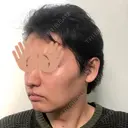 バッカルファット除去 / 脂肪吸引（顔） グロービー美容整形外科 DAY 26 サムネイル用