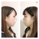 二重埋没 / バッカルファット除去 / 脂肪吸引（顔） / ヒアルロン酸注入（あご） / ボトックス（エラ・小顔） / 美容点滴・美容注射（美肌） エートップ美容整形外科 DAY 13 サムネイル用