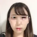 二重埋没 / バッカルファット除去 / 脂肪吸引（顔） / ヒアルロン酸注入（あご） / ボトックス（エラ・小顔） / 美容点滴・美容注射（美肌） エートップ美容整形外科 DAY 13 サムネイル用