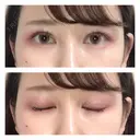 二重埋没 / バッカルファット除去 / 脂肪吸引（顔） / ヒアルロン酸注入（あご） / ボトックス（エラ・小顔） / 美容点滴・美容注射（美肌） エートップ美容整形外科 DAY 13 サムネイル用