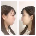 二重埋没 / バッカルファット除去 / 脂肪吸引（顔） / ヒアルロン酸注入（あご） / ボトックス（エラ・小顔） / 美容点滴・美容注射（美肌） エートップ美容整形外科 DAY 14 サムネイル用