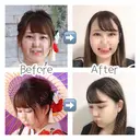 二重埋没 / バッカルファット除去 / 脂肪吸引（顔） / ヒアルロン酸注入（あご） / ボトックス（エラ・小顔） / 美容点滴・美容注射（美肌） エートップ美容整形外科 DAY 14 サムネイル用