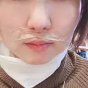 小鼻縮小（切開） / 鼻尖縮小 表参道スキンクリニック 表参道院 DAY 60 サムネイル用