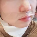 小鼻縮小（切開） / 鼻尖縮小 表参道スキンクリニック 表参道院 DAY 60 サムネイル用