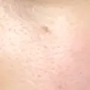 ほくろ・いぼ切除（肌） 大山皮膚科 DAY 33 サムネイル用