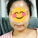 骨削り（エラ） / 骨削り（頬） / 脂肪吸引（顔） View美容整形外科 DAY 31 サムネイル用