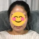 骨削り（エラ） / 骨削り（頬） / 脂肪吸引（顔） View美容整形外科 DAY 41 サムネイル用