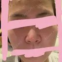 隆鼻術 / ヒアルロン酸注入（鼻） 東京ヒルズクリニック 新宿院 DAY 3 サムネイル用