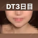バッカルファット除去 藤・ナチュレ美容クリニック 恵比寿院 DAY 3 サムネイル用