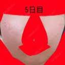 美肌レーザー / シミ取りレーザー / ルビーレーザー 銀座お肌の診療所 DAY 5 サムネイル用
