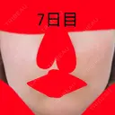 美肌レーザー / シミ取りレーザー / ルビーレーザー 銀座お肌の診療所 DAY 7 サムネイル用