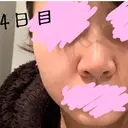 隆鼻術 / ヒアルロン酸注入（鼻） 東京ヒルズクリニック 新宿院 AFTER サムネイル用