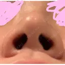 隆鼻術 / ヒアルロン酸注入（鼻） 東京ヒルズクリニック 新宿院 DAY 4 サムネイル用