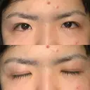 眼瞼下垂（切開） 札幌中央形成外科 DAY 25 サムネイル用