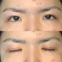 眼瞼下垂（切開） 札幌中央形成外科 DAY 29 サムネイル用