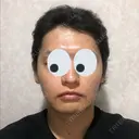 バッカルファット除去 / 脂肪吸引（顔） グロービー美容整形外科 DAY 34 サムネイル用