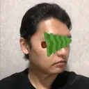 バッカルファット除去 / 脂肪吸引（顔） グロービー美容整形外科 DAY 34 サムネイル用