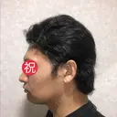 バッカルファット除去 / 脂肪吸引（顔） グロービー美容整形外科 DAY 34 サムネイル用