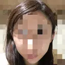 骨切り（あご） / 骨削り（エラ） / 骨削り（頬） ボンディ美容整形外科（旧リオン整形外科） DAY 82 サムネイル用