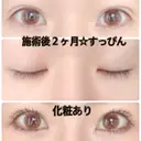 二重埋没 城本クリニック 姫路院 AFTER サムネイル用