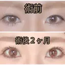 二重埋没 城本クリニック 姫路院 DAY 67 サムネイル用