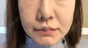 人中短縮 / 口角挙上 清潭女神美容外科 DAY 17 サムネイル用