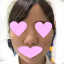 鼻中隔延長（切開） / 小鼻縮小（切開） / 軟骨移植 / 鼻尖縮小 / 鼻孔縁下降 / その他（鼻） 加美（GAMI）整形外科 AFTER サムネイル用