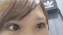 眼瞼下垂（切開） なでしこ皮膚科クリニック DAY 7 サムネイル用