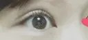 眼瞼下垂（切開） なでしこ皮膚科クリニック DAY 193 サムネイル用