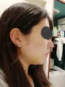 二重埋没 / 小鼻縮小（切開） / その他（鼻） / 骨切り（あご） / 軟骨移植 バノバギ整形外科 DAY 7 サムネイル用