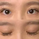 二重埋没 札幌中央形成外科 DAY 15 サムネイル用