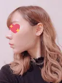 脂肪吸引（顔） / ボトックス（あご） / ボトックス（エラ・小顔） エートップ美容整形外科 DAY 280 サムネイル用