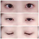 二重埋没 / 眼瞼下垂（切開） / クマ治療 / 下まぶたの脂肪取り THE MEDICAL SALON DAY 32 サムネイル用