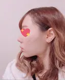 脂肪吸引（顔） / ボトックス（あご） / ボトックス（エラ・小顔） エートップ美容整形外科 AFTER サムネイル用
