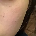 美肌レーザー / シミ取りレーザー / 美白レーザー 銀座みゆき通り美容外科 大阪梅田院 DAY 2 サムネイル用